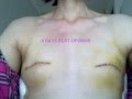 MASTECTOMY WITH TISSUE EXPANDERS~FROM START TO FINISH