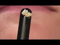 Tonsil stones removal - Tonsillectomy Surgery