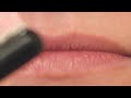Tonsil stones removal - Tonsillectomy Surgery