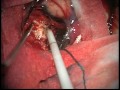 Melanoma brain metastasis