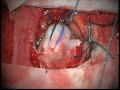 Melanoma brain metastasis