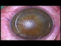 LASER SURGERY,LASIK Refractive Surgery (dripping technique)by Dr.Kawa Qaradaghi