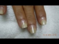 Video: Nail Fungus-Laser Treatment-Valley Aesthetics