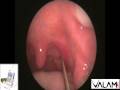 Tonsil Stone Extraction with Laser Cryptolysis