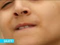 Atassia teleangectasia Atassia teleangectasia