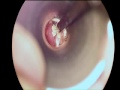 Ear Wax Extraction!!!!!