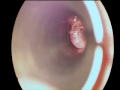 Ear Wax Extraction!!!!!