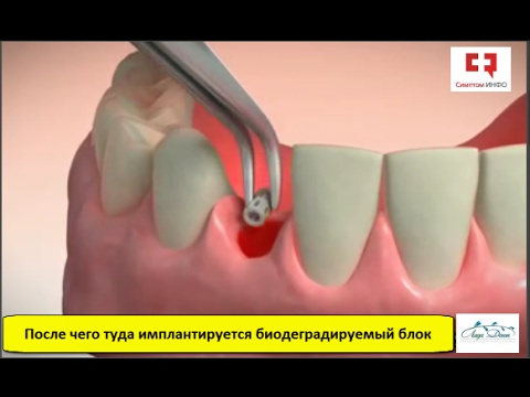 Как проверить после удаления зуба Как проверить после удаления зуба