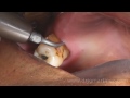 Atraumatic Tooth Extraction with LC1-Tip for Piezotome (Dr_Juan_Martinez)