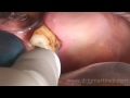 Atraumatic Tooth Extraction with LC1-Tip for Piezotome (Dr_Juan_Martinez)