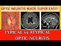 OPTIC NEURITIS  Typical optic neuritis and atypical optic neuritis