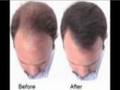 Find a Hair Thinning Remedy That Works