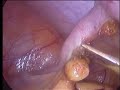 Appendix Operation by Dr.Kuldeep