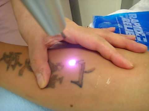 Nd yag Laser tattoo removal, birth mark removal treatment.