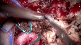 Микронейрохирургическое удаление внутримозгового кистозного объемного образования правой теменно-затылочной доли