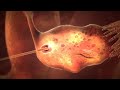 3D animation of how IVF works
