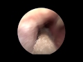 Endoscopic Myringotomy (Ear Drainage)