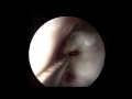 Endoscopic Myringotomy (Ear Drainage)