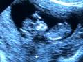 Sonogram Pregnancy 12 weeks- Embarazo 12 semanas-