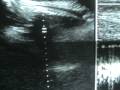 Corazón fetal 32 semanas de Gestación - Fetal heart of 32 weeks of Gestation