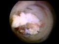 Lateral Transforaminal Endoscopic Spinal Decompression of my S1/L5 level video #2