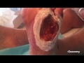 Bugs Bites & Parasites - Necrotitis Fasciitis