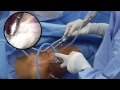 Hip Arthroscopy From Fundamentals to FAI and Labral Repair by JW Thomas Byrd MD
