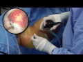 Hip Arthroscopy From Fundamentals to FAI and Labral Repair by JW Thomas Byrd MD