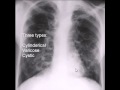 chest x-ray, bronchiectasis