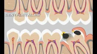 Лечение зуба мудрости - стоматология