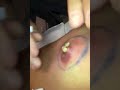 Gran Explosion de un Grano Pus Exploding Nipple