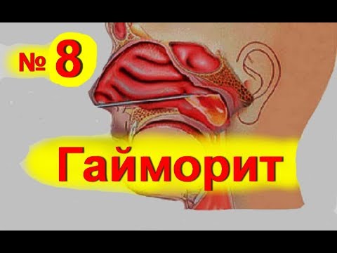 Лечение синусита в домашних условиях народными средствами Лечение синусита в домашних условиях народными средствами