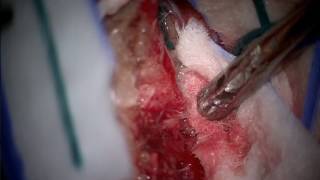 Микрохирургическое удаление парасаггитальной менингиомы средней/задней трети ВСС