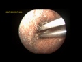 EAR WAX REMOVAL USING FORCEPS