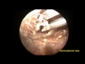 EAR WAX REMOVAL USING FORCEPS