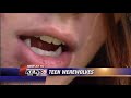 Teen Werewolves
