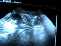 18 Weeks Pregnant - Gestación 18 semanas