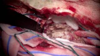 Микрохирургическое удаление гигантского внемозгового объемного образования ПЧЯ