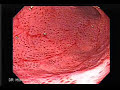 Gastritis Endoscopy