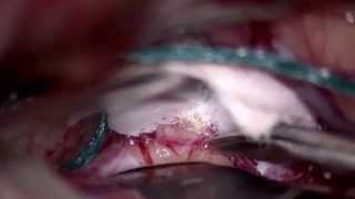Неразорвавшаяся мешотчатая аневризма передней соединительной артерии