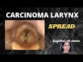 088.Spread of Cancer Larynx  Part 12  #carcinoma #larynx