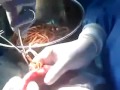 Removing Intestinal Worms and Parasites from a 3 Year Old