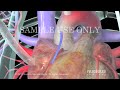 Koronararterien-Bypass (CABG)
