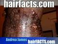 Laser Hair Removal Injury to Dark Skin