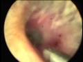 Live Cockroach in the Ear - Dr Ahilasamy ENT