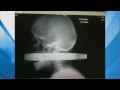 X-Ray: Man Impaled by Pipe in Head Survives