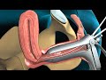 3D Medical Animation: Endometrial Biopsy of the Uterus
