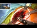 Total Hip Replacement (Anterior Approach, Minimally Invasive) - Operation