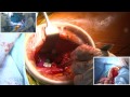 Total Hip Replacement (Anterior Approach, Minimally Invasive) - Operation