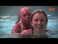 Teenager Suffering From Rare Harlequin Syndrome